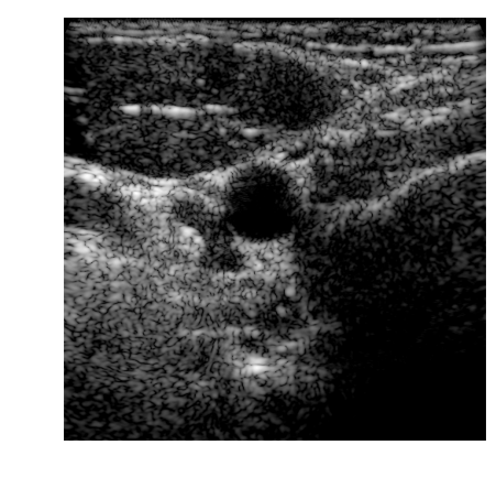 B-mode carotid image