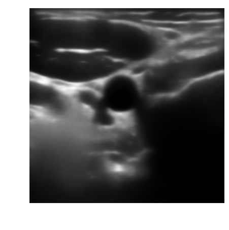 Despeckled B-mode carotid image