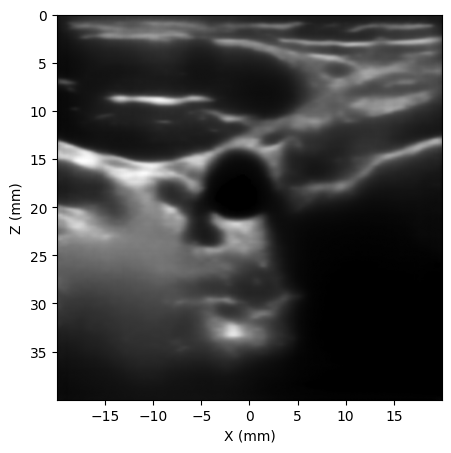 Despeckled B-mode carotid image