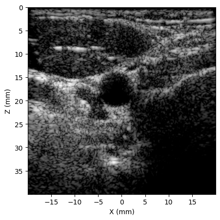 B-mode carotid image